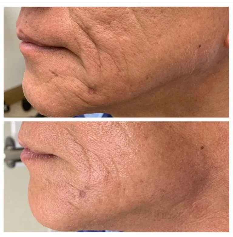 Before-and-after comparison of the lower face and jawline