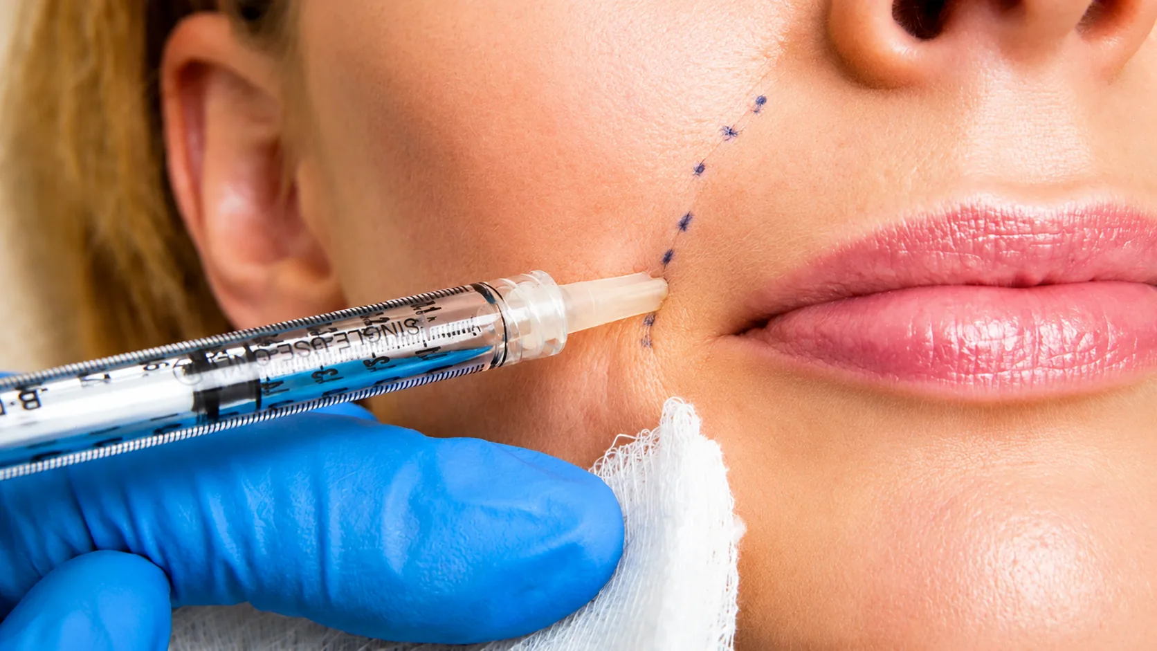 Dermal Fillers