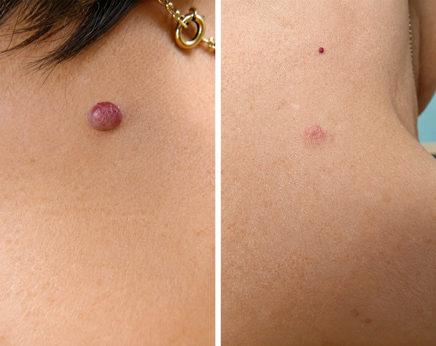 Precise Removal for Flawless Skin