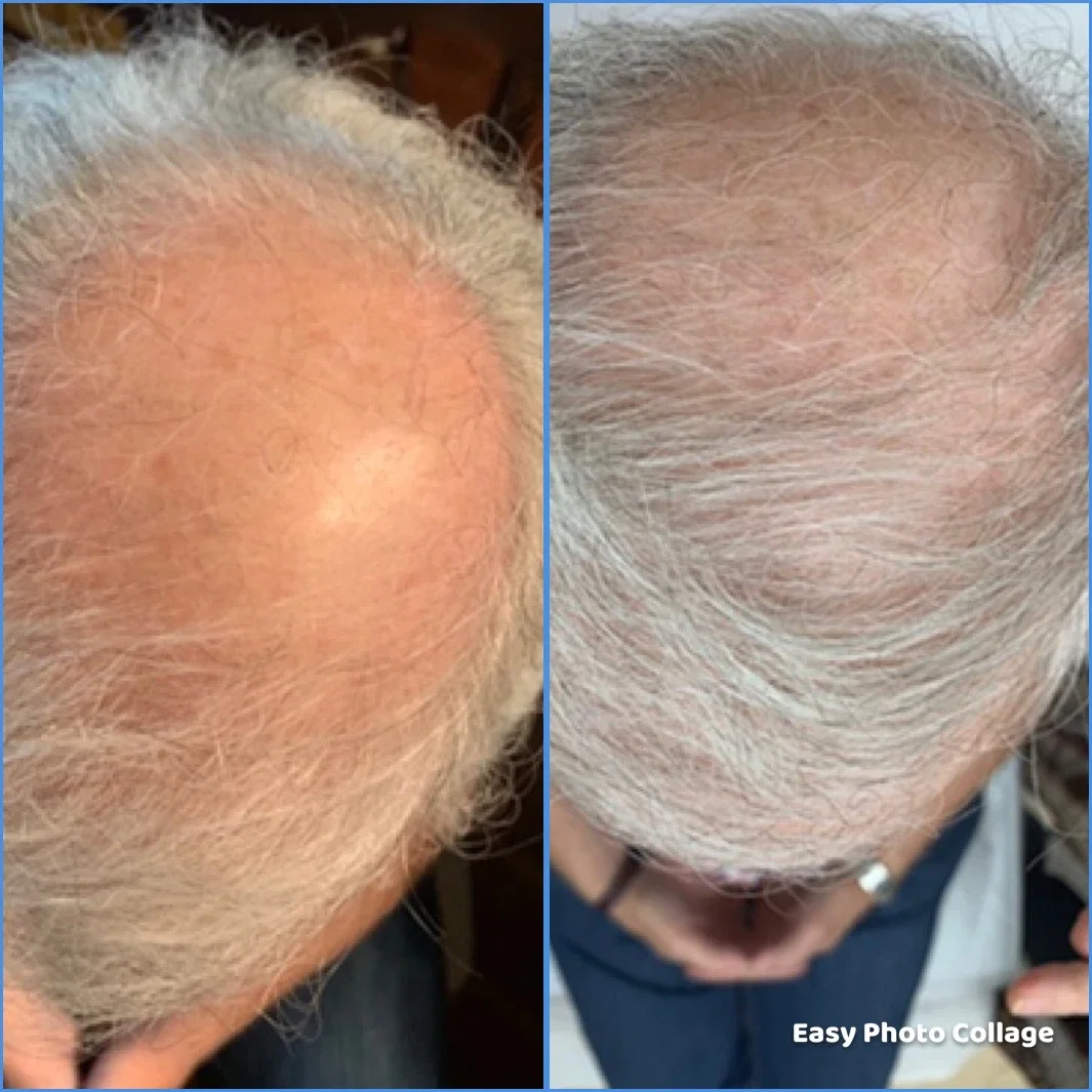 The Only Guide to Low Level Laser Therapy (Lllt) - Lllt Hair Treatment Near Me
