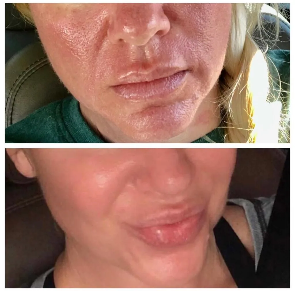 Before-and-after comparison of facial skin texture