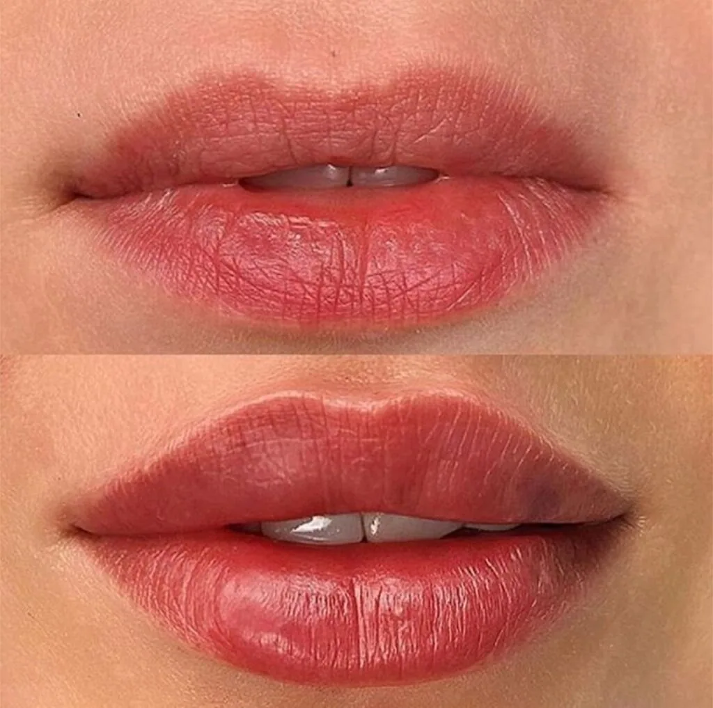 Natural Lip Volumization