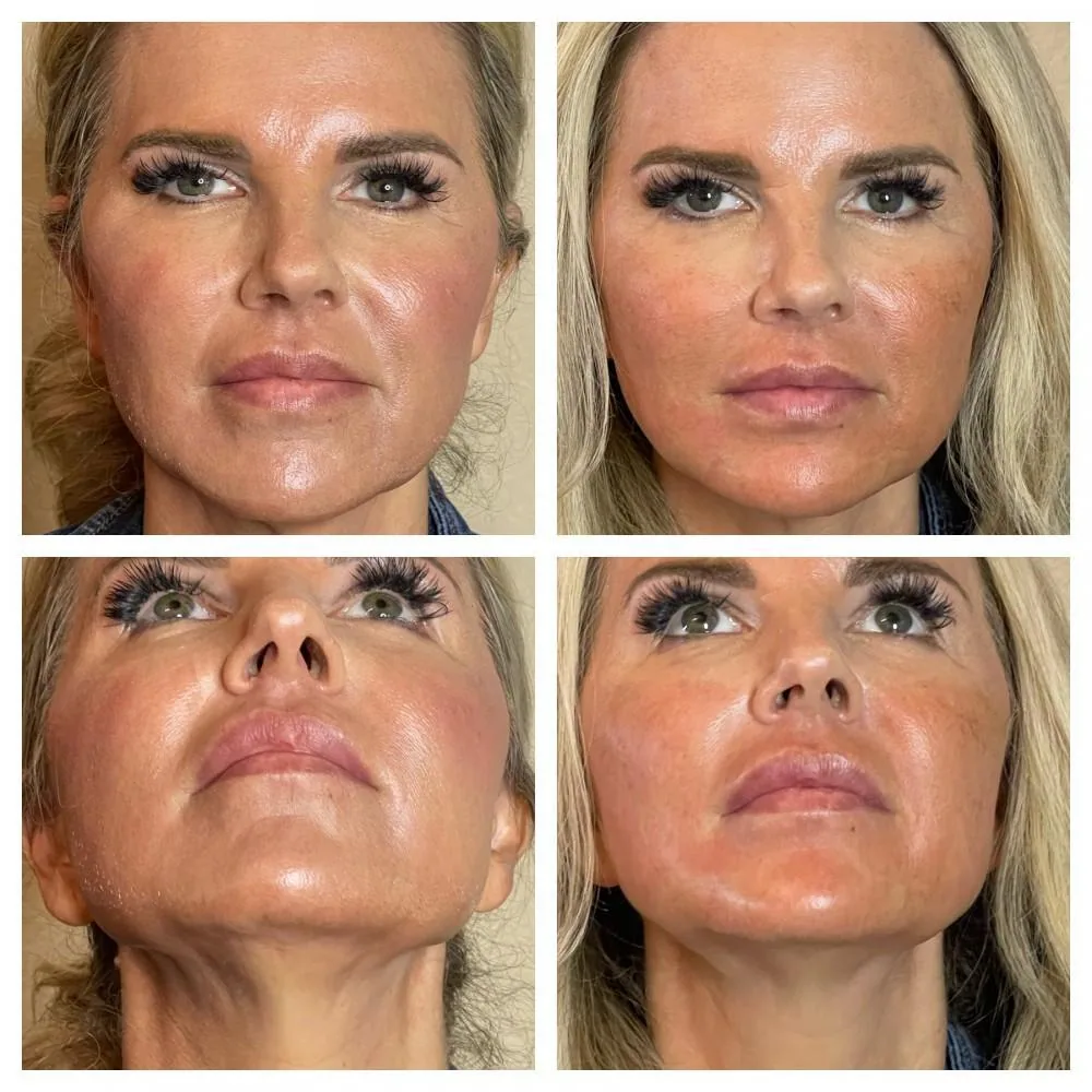 Body Contouring at BUTEX Medical Spa in Frisco, TX